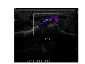 Fig 3. Forefoot Imaging: Synovitis big toe IP joint
