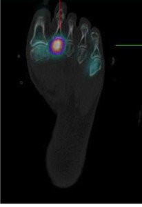 Fig 5. Forefoot Imaging: SPECT-CT bone scan showing stress injury 2nd metatarsal head. Click to enlarge.