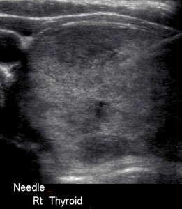 Figure 3. Large nodule undergoing a fine needle biopsy