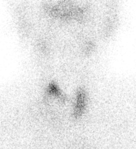 Figure 4. Large cold nodule in right lobe of thyroid on nuclear scan.