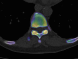 Thoracic facet joint arthrosis using xSPECT-CT bone